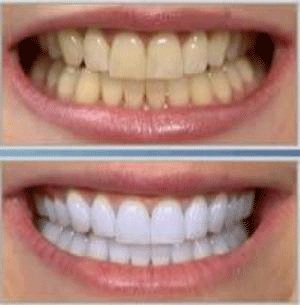 سفید کردن دندان ها به روش طبیعی
